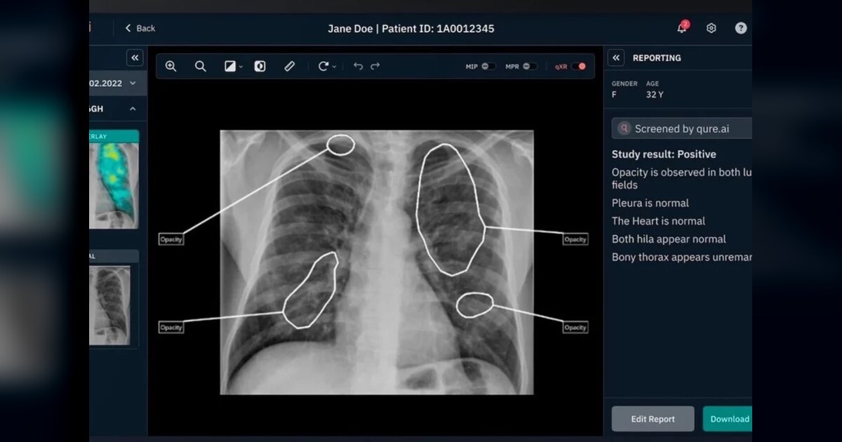 Ateneo Study: AI X-Ray Reading Could Lower TB Screening Costs, Model Shows